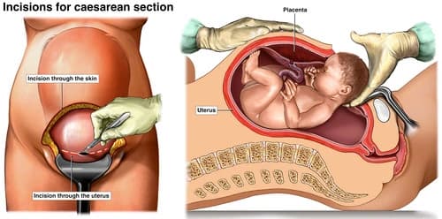 Vaginal Delivery